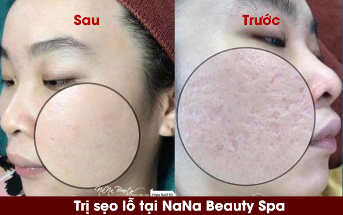 Trị mụn hiệu quả ở Vinh với Nana beauty Spa